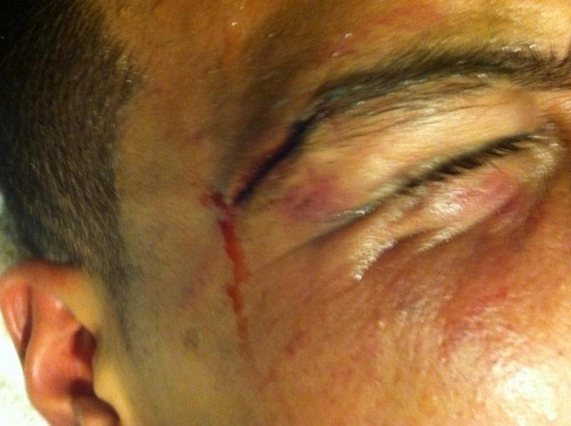 Abel Ramos eye injury
